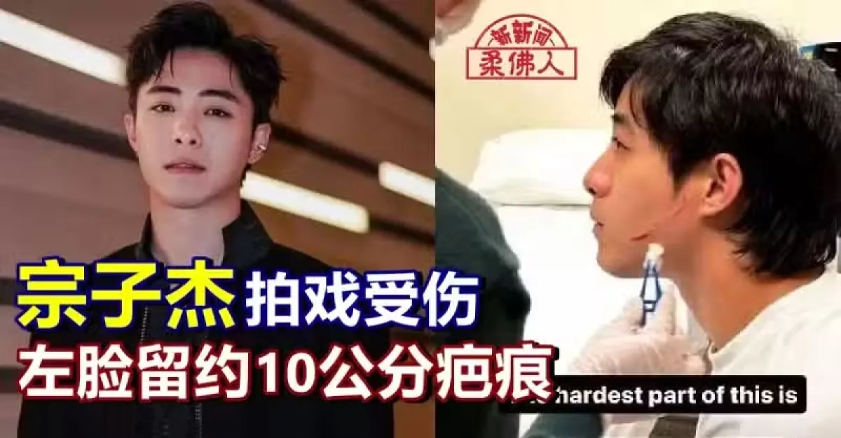 宗子杰拍戏受伤 左脸留约10公分疤痕 | 狮城新闻 | 新加坡新闻